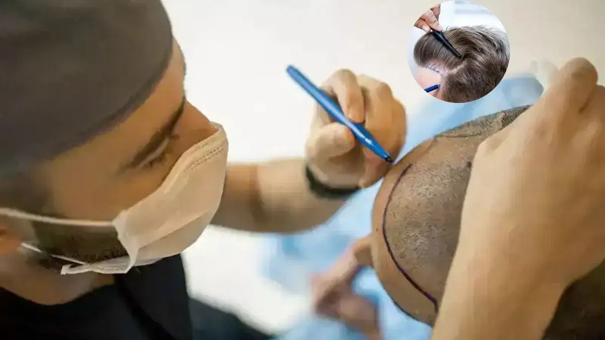 <p><span style="color: rgb(224, 62, 45);" data-mce-style="color: rgb(224, 62, 45);"><strong>હેર ટ્રાન્સપ્લાન્ટ કરાવ્યું છે?</strong></span> તો સારા પરિણામ માટે આટલી બાબતોનું ખાસ ધ્યાન રાખો, નહિતર મહેનત જશે પાણીમાં!</p>