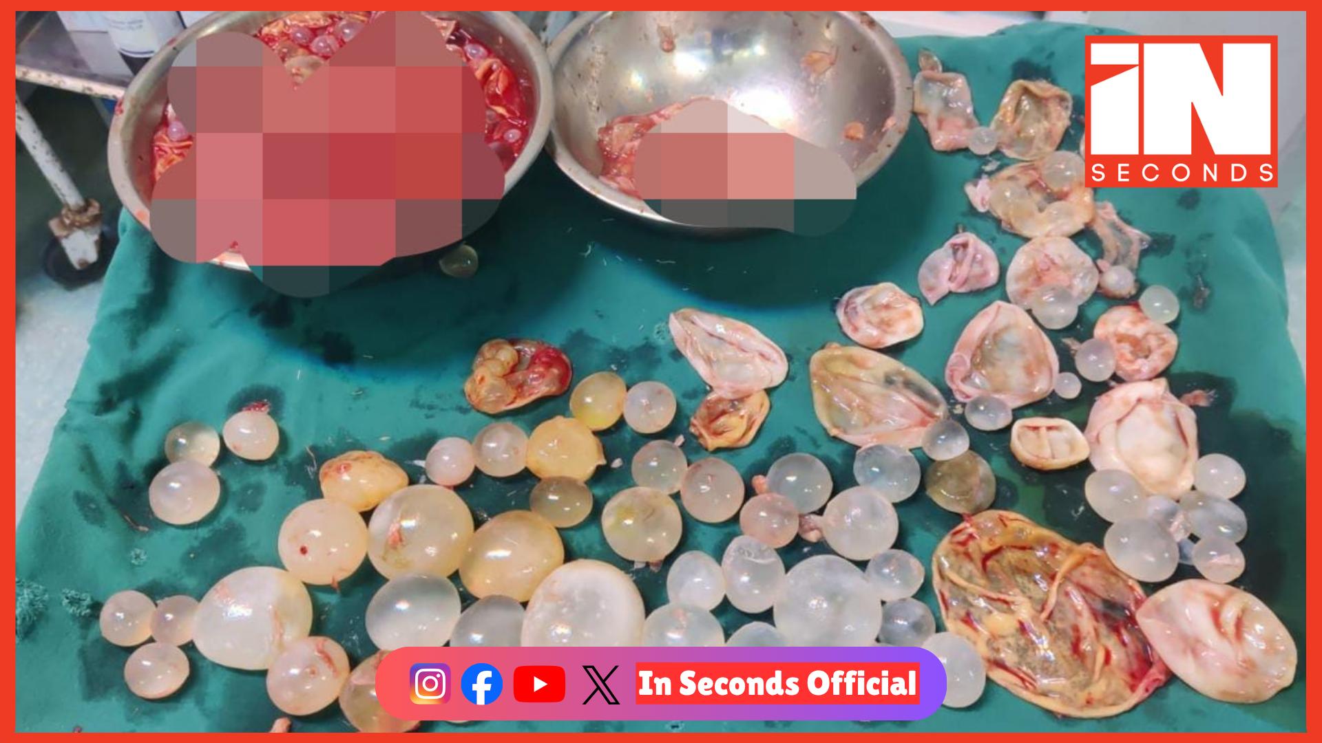 <p><strong><span style="color: rgb(224, 62, 45);" data-mce-style="color: rgb(224, 62, 45);">ગાંધીનગર સિવિલમાં લીવર સર્જરીથી યુવાનને નવજીવન: </span>યુવાનના લીવરમાંથી હજારો ‘ડોટર સિસ્ટ’ દૂર કરી અપાવ્યું નવજીવન</strong></p>